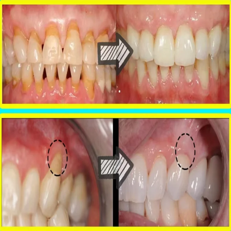 ได้อย่างรวดเร็ว Repair Gum Ser - Teeth Whitening Baking Soda บทวิจารณ์และราคา