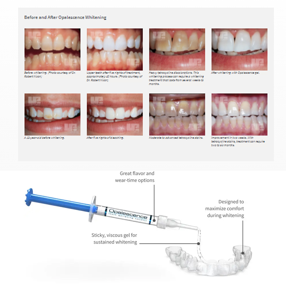 20% pF 20 16ชุดเจล8x1.2มล. ชุด - Teeth Whitening Home Kit บทวิจารณ์และราคา