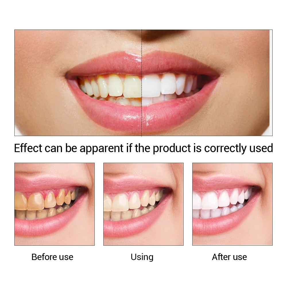 FTEENPLY ฟันไวท์เทนนิ่ง Oral ส - Teeth Paint Whitening บทวิจารณ์และราคา