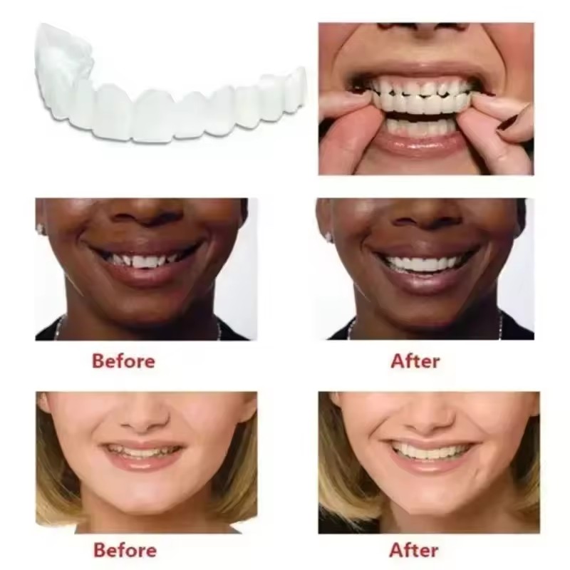 วีเนียร์ฟัน ฟอกสีฟัน ฟันปลอม ท - Teeth Whitening Veneers บทวิจารณ์และราคา