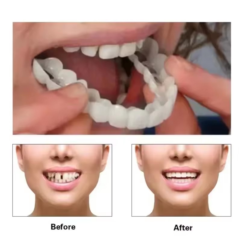 วีเนียร์ฟัน ฟอกสีฟัน ฟันปลอม ท - Teeth Whitening Veneers บทวิจารณ์และราคา