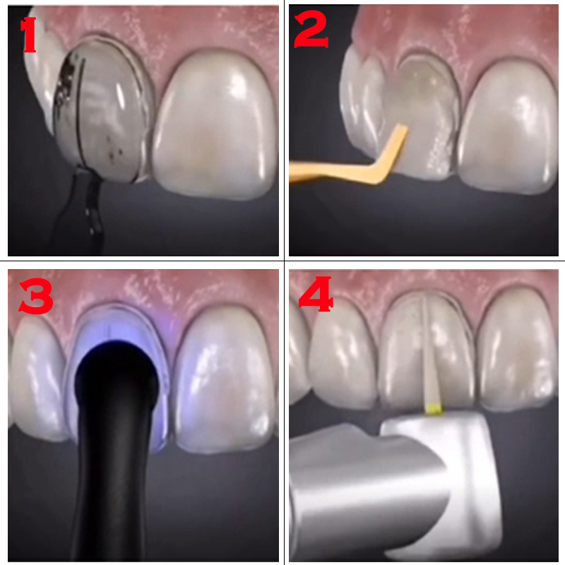 แม่พิมพ์ฟันสำหรับวีเนียร์เรซิน - Teeth Whitening Veneers บทวิจารณ์และราคา